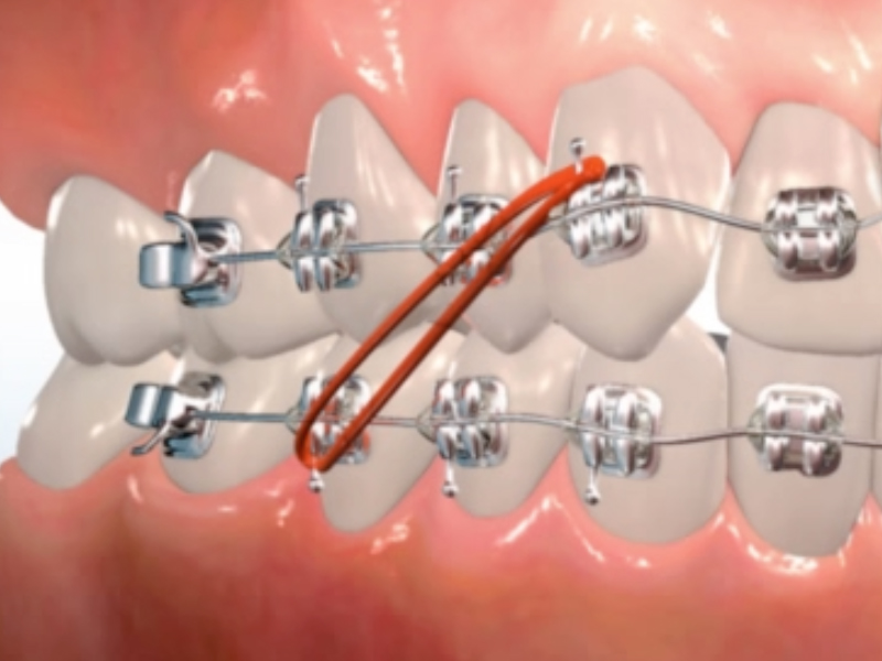What role do elastics (rubber bands) play in orthodontics? - Dr. Mike  Mizell Orthodontist